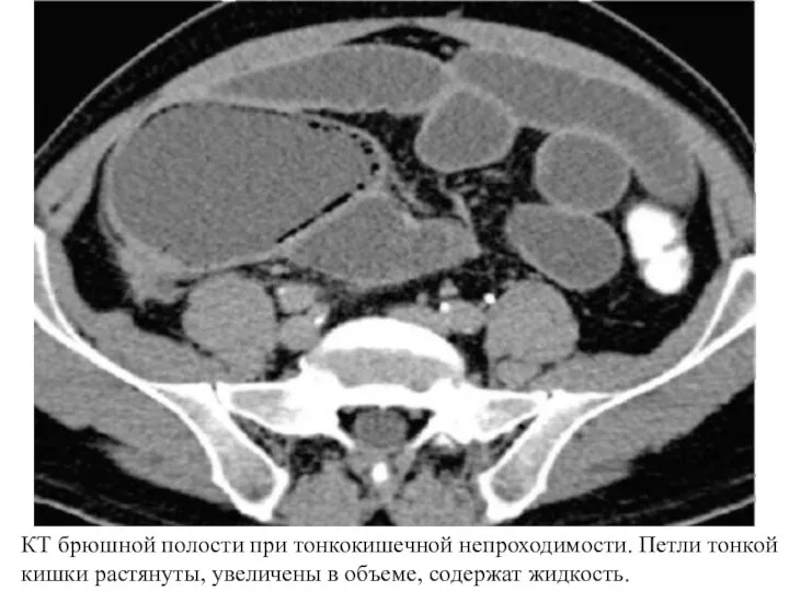 КТ брюшной полости при тонкокишечной непроходимости. Петли тонкой кишки растянуты, увеличены в объеме, содержат жидкость.