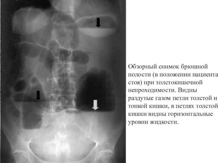 Обзорный снимок брюшной полости (в положении пациента стоя) при толстокишечной непроходимости. Видны раздутые