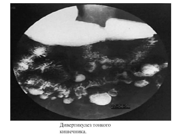 Дивертикулез тонкого кишечника.