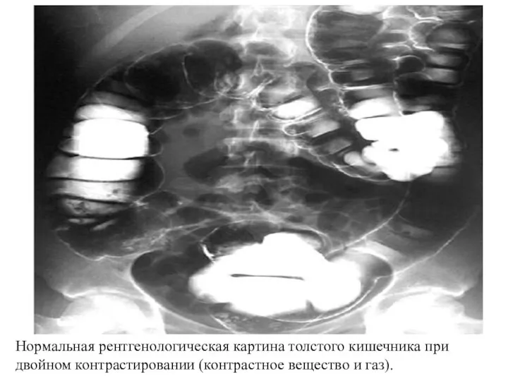 Нормальная рентгенологическая картина толстого кишечника при двойном контрастировании (контрастное вещество и газ).