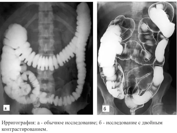 Ирригография: а - обычное исследование; б - исследование с двойным контрастированием.