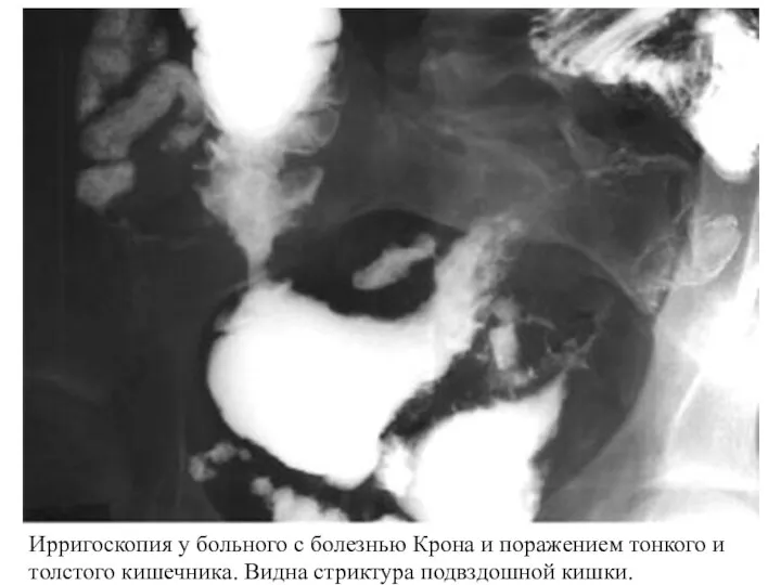 Ирригоскопия у больного с болезнью Крона и поражением тонкого и толстого кишечника. Видна стриктура подвздошной кишки.