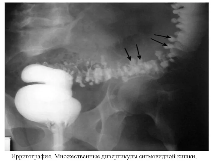 Ирригография. Множественные дивертикулы сигмовидной кишки.