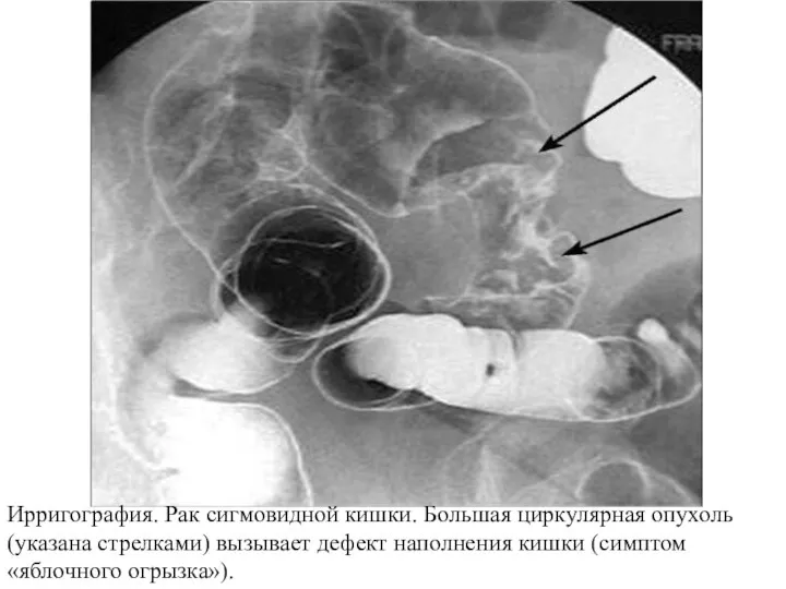 Ирригография. Рак сигмовидной кишки. Большая циркулярная опухоль (указана стрелками) вызывает дефект наполнения кишки (симптом «яблочного огрызка»).