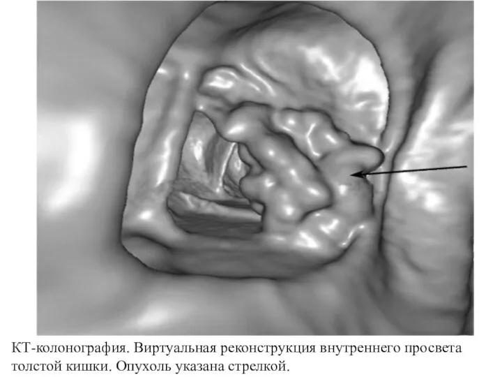 КТ-колонография. Виртуальная реконструкция внутреннего просвета толстой кишки. Опухоль указана стрелкой.