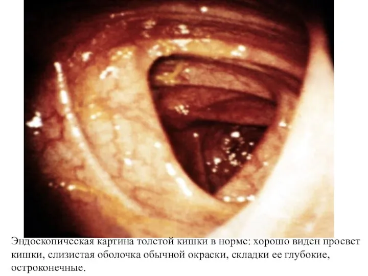 Эндоскопическая картина толстой кишки в норме: хорошо виден просвет кишки, слизистая оболочка обычной