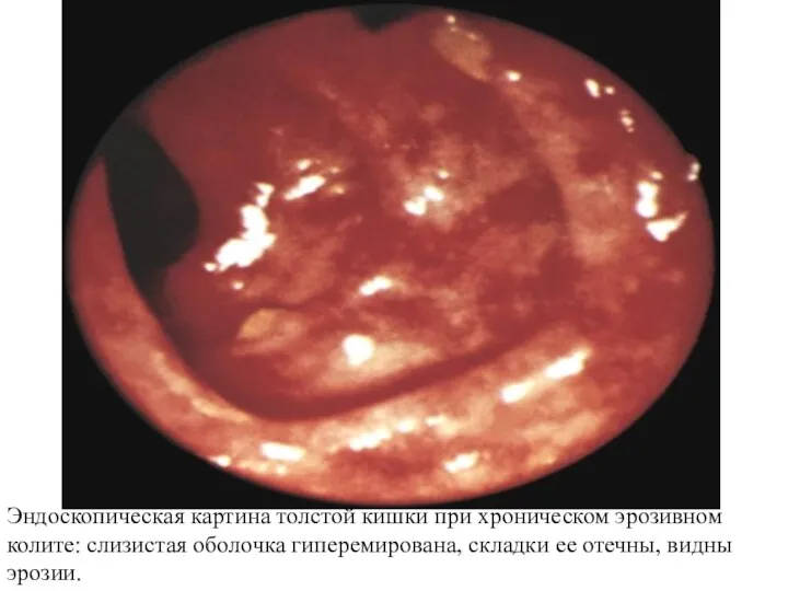 Эндоскопическая картина толстой кишки при хроническом эрозивном колите: слизистая оболочка гиперемирована, складки ее отечны, видны эрозии.