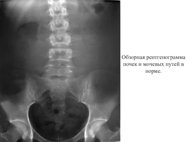 Обзорная рентгенограмма почек и мочевых путей в норме.