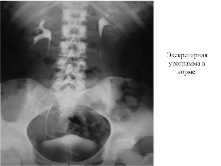 Экскреторная урограмма в норме.