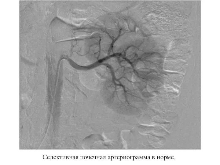 Селективная почечная артериограмма в норме.