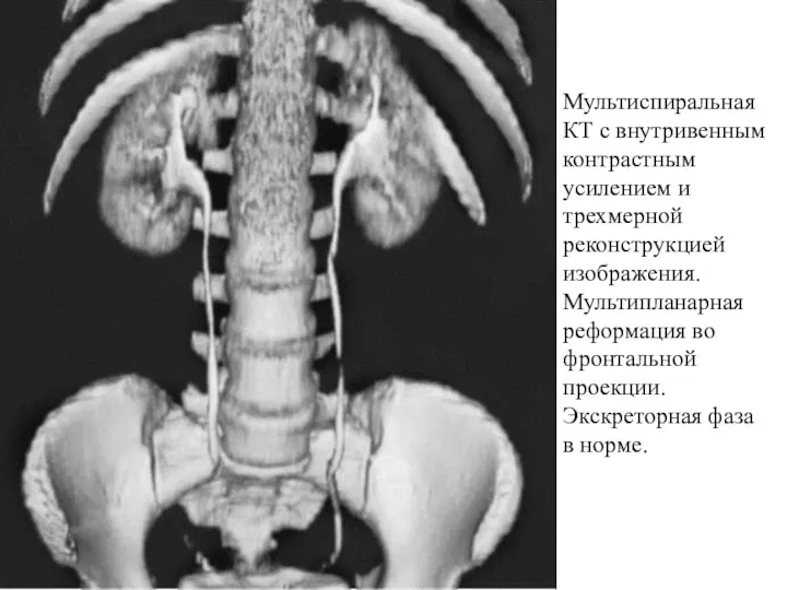 Мультиспиральная КТ с внутривенным контрастным усилением и трехмерной реконструкцией изображения. Мультипланарная реформация во