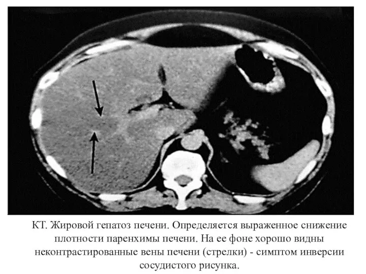 КТ. Жировой гепатоз печени. Определяется выраженное снижение плотности паренхимы печени. На ее фоне