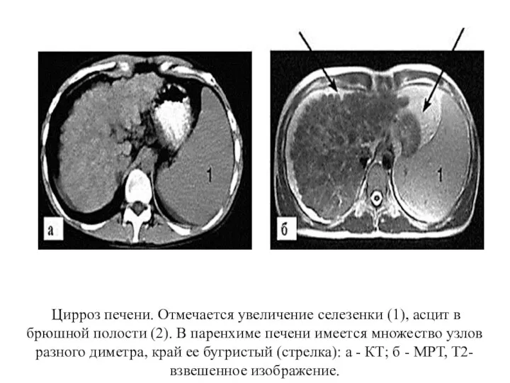 Цирроз печени. Отмечается увеличение селезенки (1), асцит в брюшной полости (2). В паренхиме