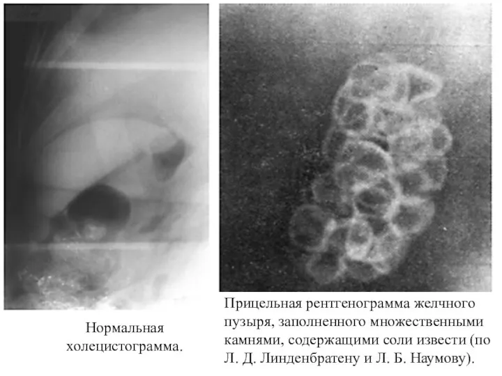 Нормальная холецистограмма. Прицельная рентгенограмма желчного пузыря, заполненного множественными камнями, содержащими соли извести (по