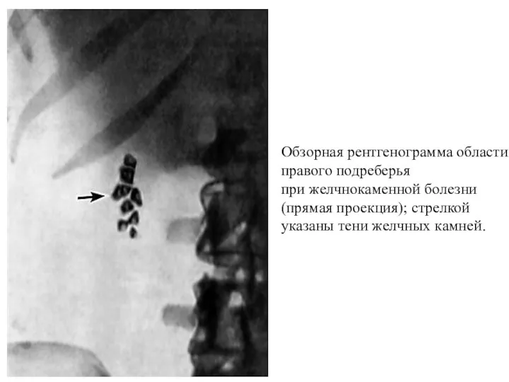 Обзорная рентгенограмма области правого подреберья при желчнокаменной болезни (прямая проекция); стрелкой указаны тени желчных камней.