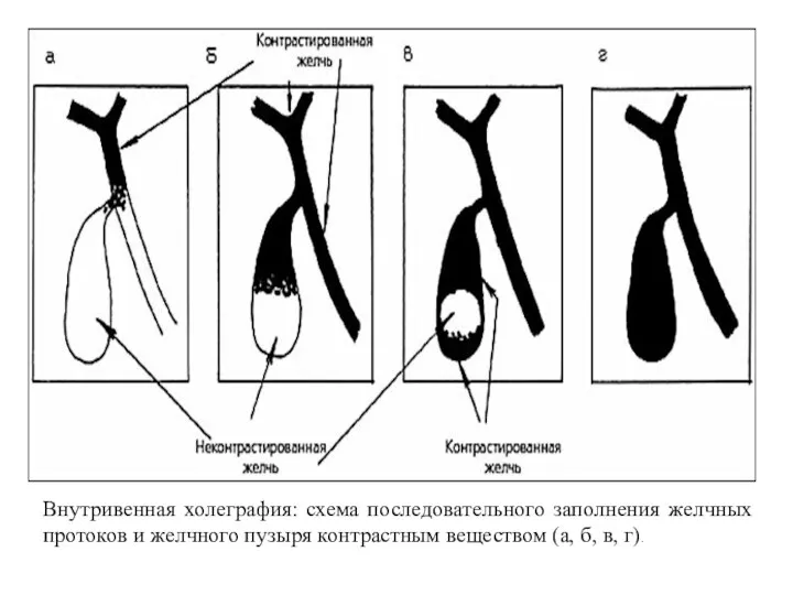 Внутривенная холеграфия: схема последовательного заполнения желчных протоков и желчного пузыря контрастным веществом (а, б, в, г).