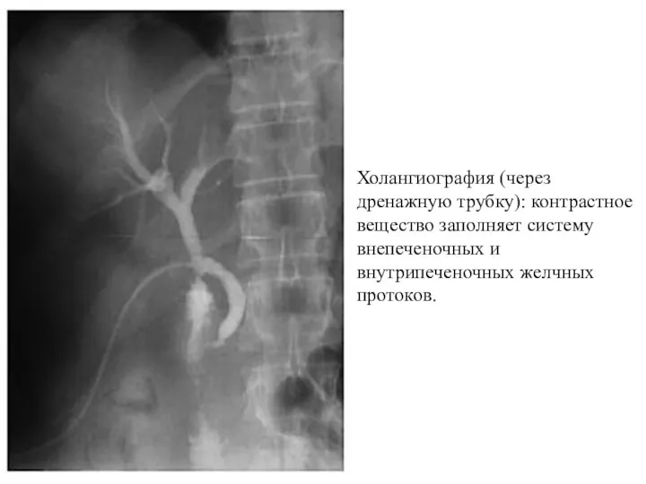 Холангиография (через дренажную трубку): контрастное вещество заполняет систему внепеченочных и внутрипеченочных желчных протоков.