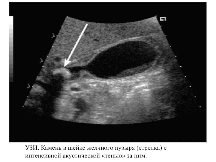 УЗИ. Камень в шейке желчного пузыря (стрелка) с интенсивной акустической «тенью» за ним.