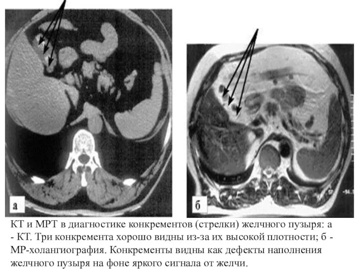 КТ и МРТ в диагностике конкрементов (стрелки) желчного пузыря: а - КТ. Три