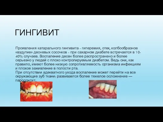 ГИНГИВИТ Проявления катарального гингивита - гиперемия, отек, колбообразное «вздутие» десневых