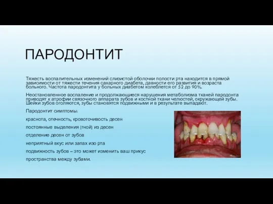 ПАРОДОНТИТ Тяжесть воспалительных изменений слизистой оболочки полости рта находится в