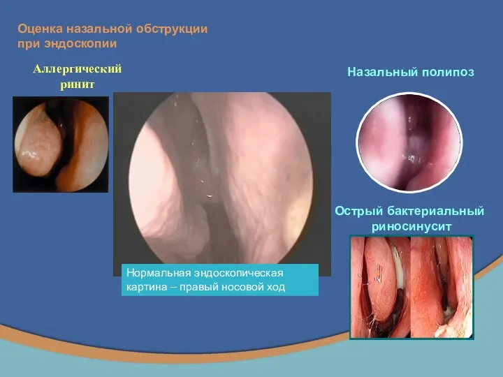 Оценка назальной обструкции при эндоскопии Нормальная эндоскопическая картина – правый