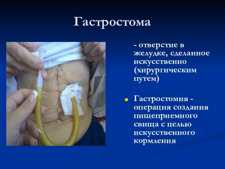 Гастростома - отверстие в желудке, сделанное искусственно (хирургическим путем) Гастростомия