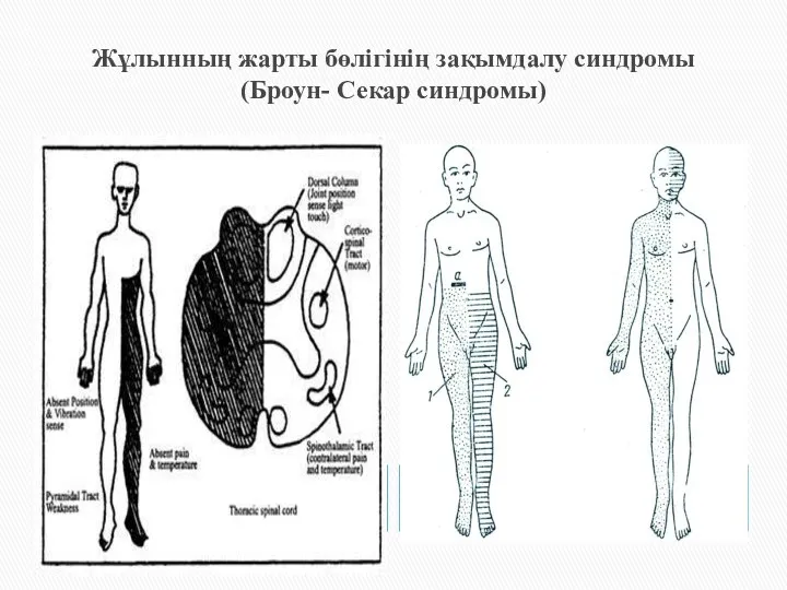 Жұлынның жарты бөлігінің зақымдалу синдромы (Броун- Секар синдромы)