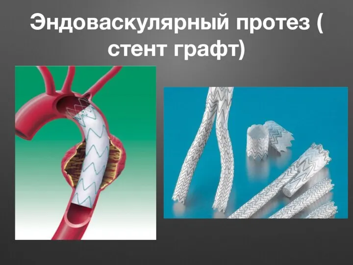 Эндоваскулярный протез ( стент графт)