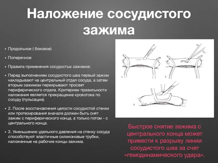 Наложение сосудистого зажима Продольное ( боковое) Поперечное Правила применения сосудистых