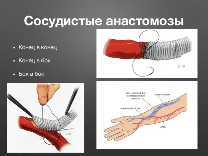 Сосудистые анастомозы Конец в конец Конец в бок Бок в бок