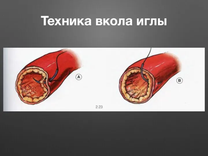 Техника вкола иглы