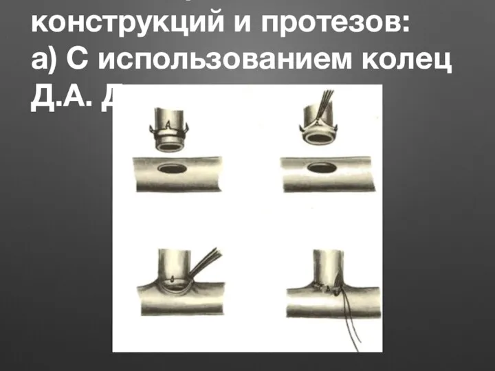 3.Швы с применением конструкций и протезов: а) С использованием колец Д.А. Донецкого