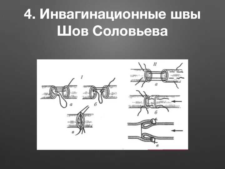 4. Инвагинационные швы Шов Соловьева