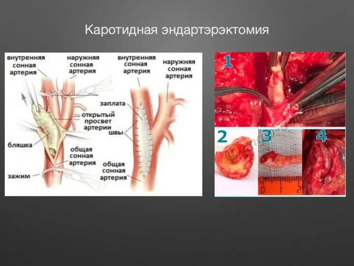 Каротидная эндартэрэктомия