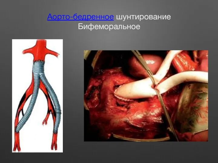 Аорто-бедренное шунтирование Бифеморальное