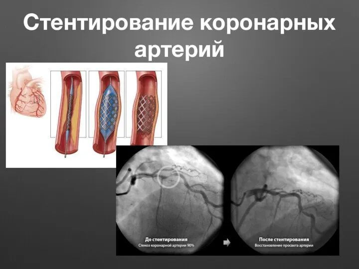 Стентирование коронарных артерий