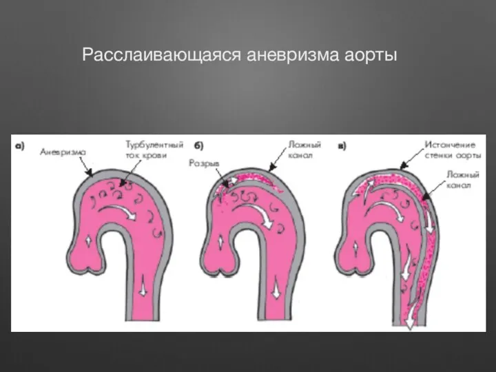 Расслаивающаяся аневризма аорты