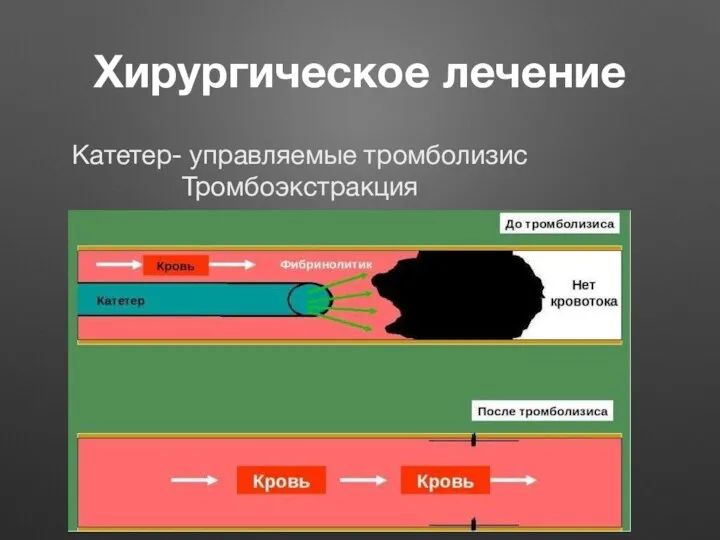 Хирургическое лечение Катетер- управляемые тромболизис Тромбоэкстракция