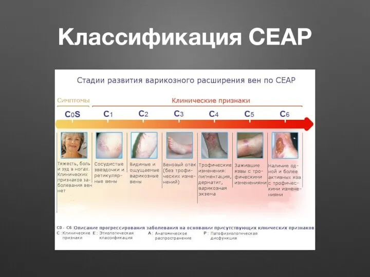 Классификация CEAP