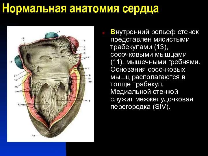 Нормальная анатомия сердца Внутренний рельеф стенок представлен мясистыми трабекулами (13),