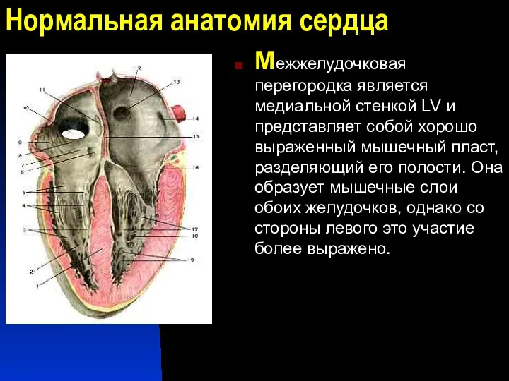 Нормальная анатомия сердца Межжелудочковая перегородка является медиальной стенкой LV и