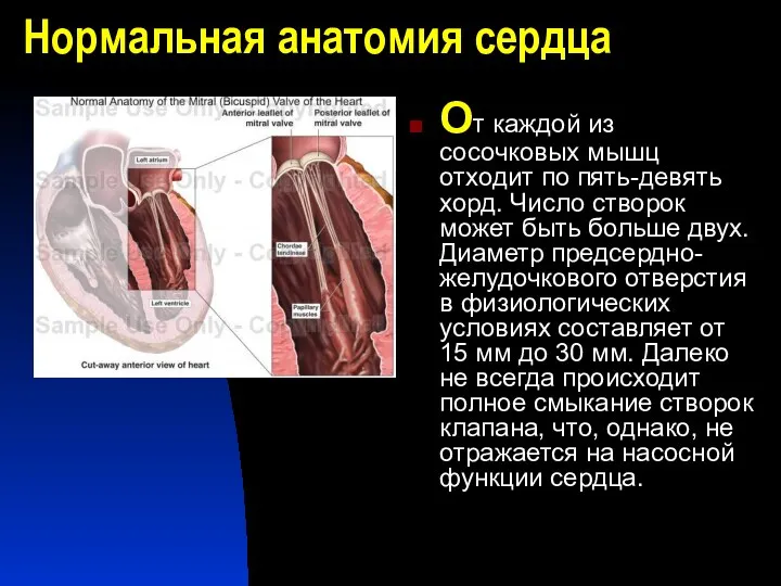 Нормальная анатомия сердца От каждой из сосочковых мышц отходит по