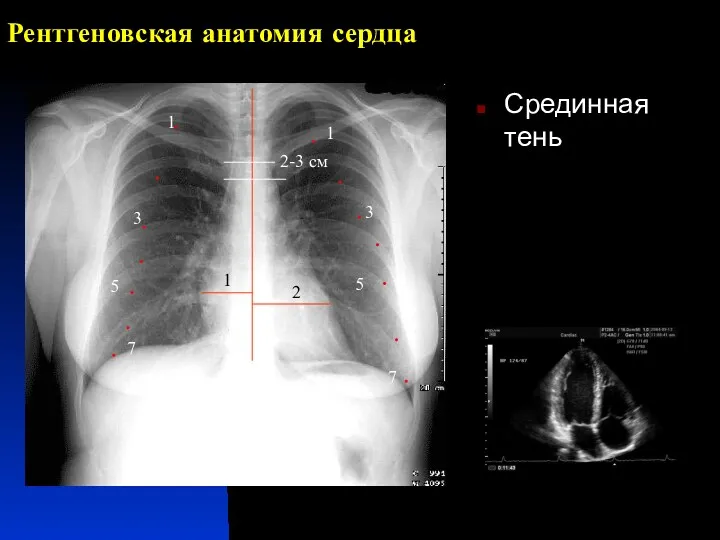 Рентгеновская анатомия сердца Срединная тень 1 1 3 3 5