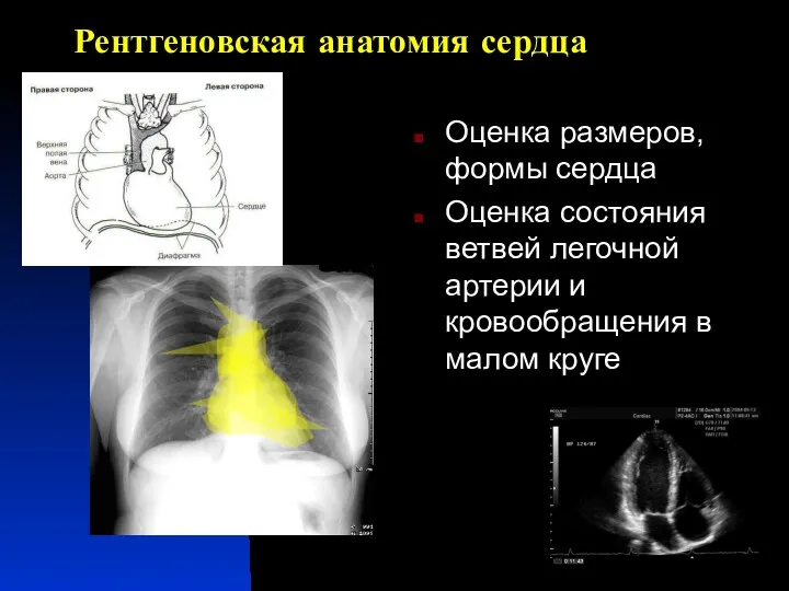 Рентгеновская анатомия сердца Оценка размеров, формы сердца Оценка состояния ветвей