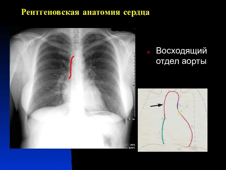 Рентгеновская анатомия сердца Восходящий отдел аорты