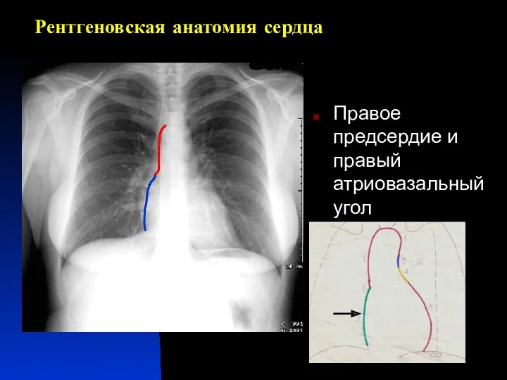 Рентгеновская анатомия сердца Правое предсердие и правый атриовазальный угол