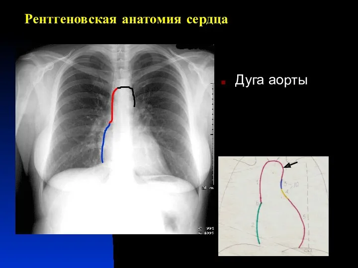 Рентгеновская анатомия сердца Дуга аорты