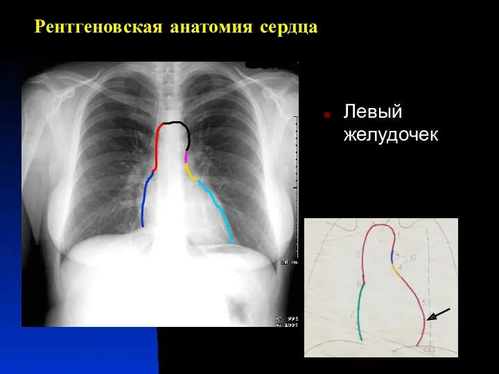 Рентгеновская анатомия сердца Левый желудочек