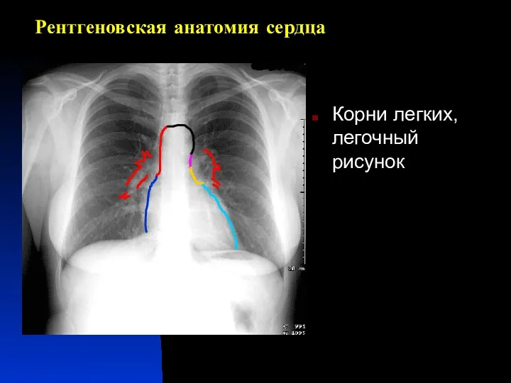 Рентгеновская анатомия сердца Корни легких, легочный рисунок